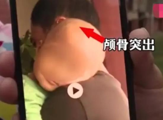 湖南郴州“大头娃娃”事件真相：不是奶粉，专家称谋财害命！